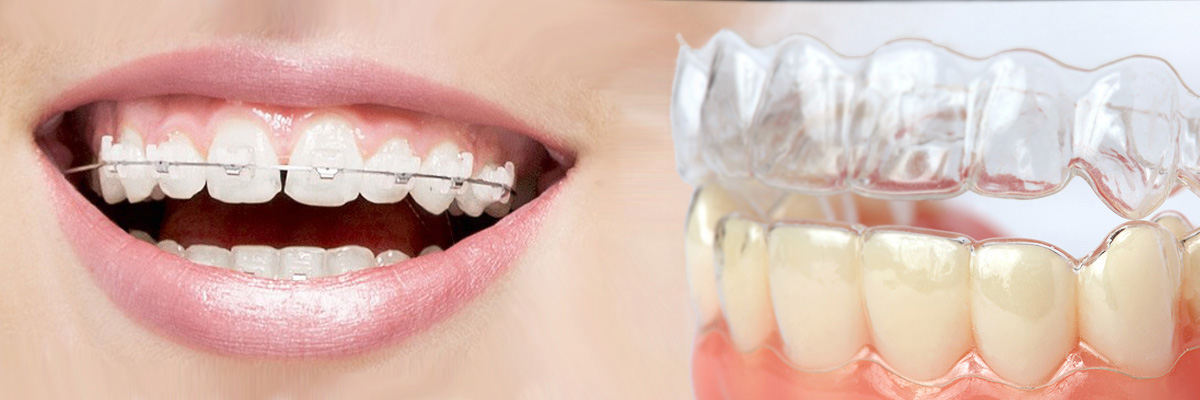 Irvine Which is Better Invisalign or Braces