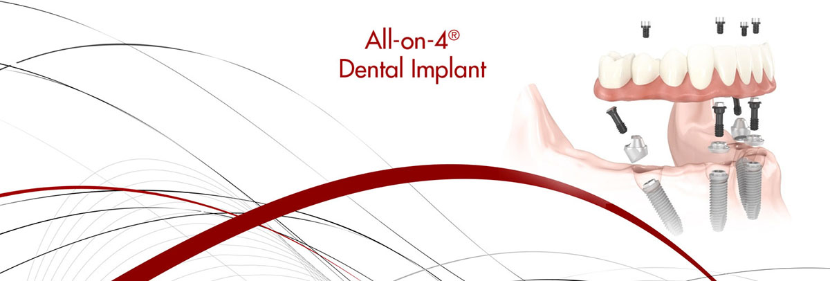 Irvine All-on-4 Dental Implants
