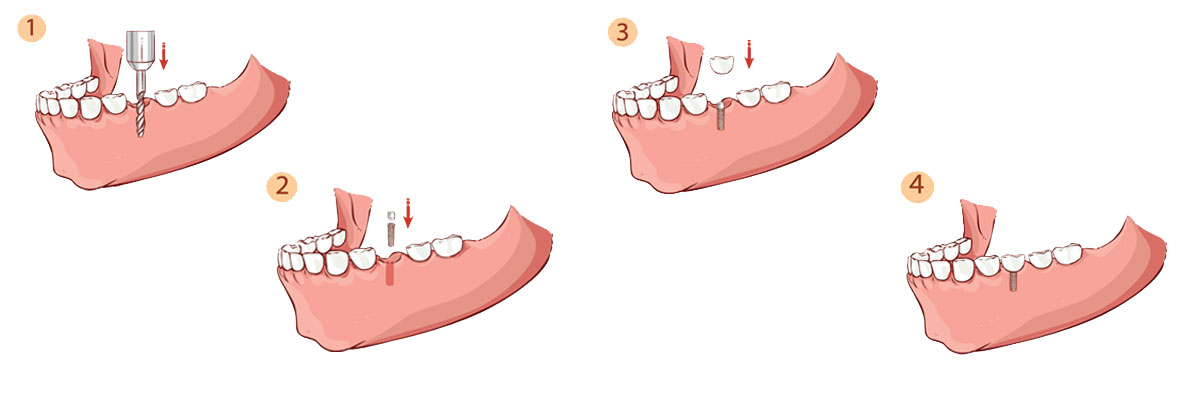 Irvine The Dental Implant Procedure